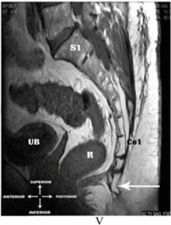 MRI Coccyx Spicule