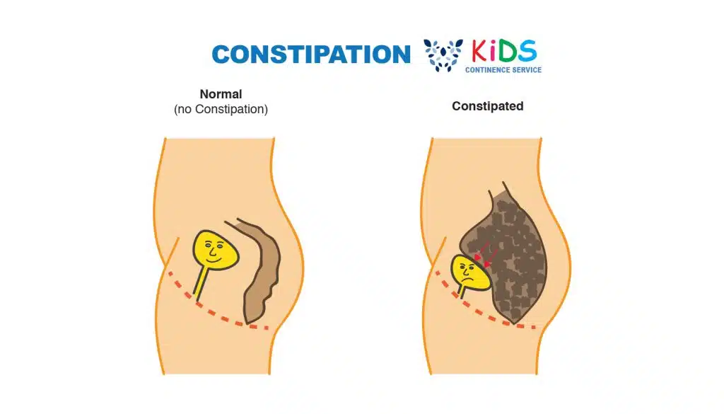 Continence In Kids, Constipation, What's 'Normal